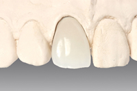 オールセラミッククラウン