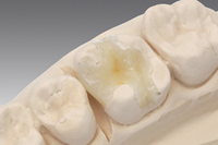 セラミックインレー