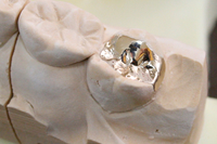 金の奥歯の詰め物