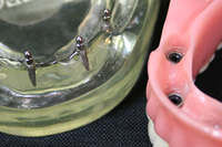 インプラントデンチャー