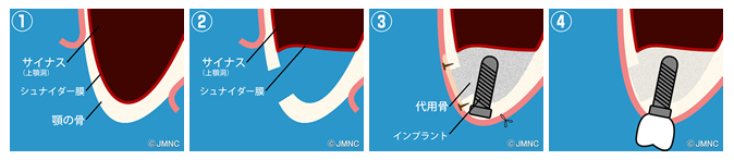 サイナスリフト