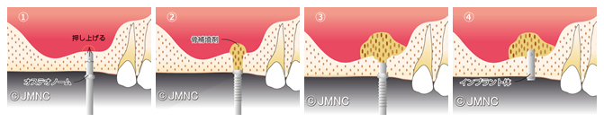 ソケットリフト