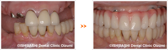 前歯:ボーンアンカードブリッジ