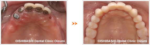 上顎:ボーンアンカードブリッジ