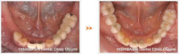 下顎:ボーンアンカードブリッジ