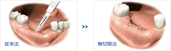 切らない手術