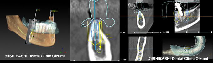 インプラントの3D立体画像