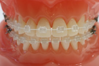 目立たない矯正